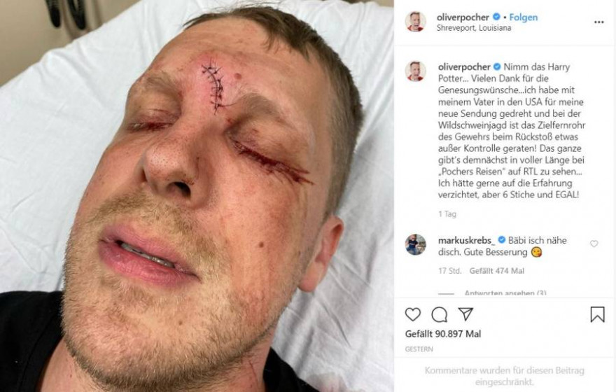 Dieses Foto postete Pocher aus dem Krankenhaus, in dem seine Platzwunde mit 6 Stichen genäht wurde (Quelle: Screenshot Instagram)