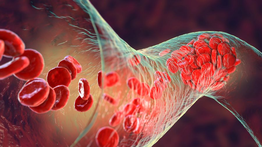 Blutgerinnsel aus roten Blutkörperchen, Blutplättchen und Fibrinproteinsträngen. (Quelle: iStock/Dr_Microbe)